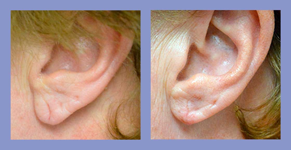 Ear Lobe Repair Surgery, Ear Lobe Repair Treatment - Sakhiya Skin Clinic