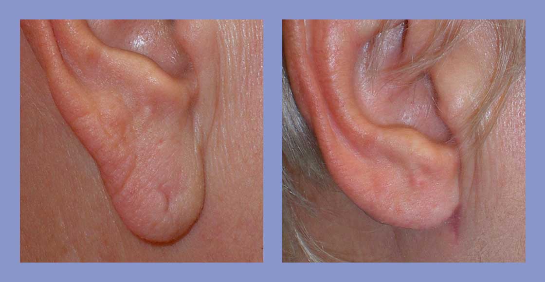 Ear Lobe Repair - Before and After