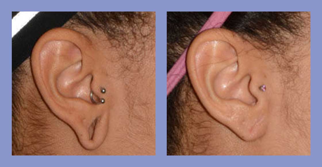 Ear Lobe Repair - Before and After