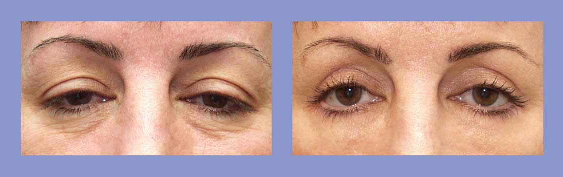 Eyelid Surgery - Before and After