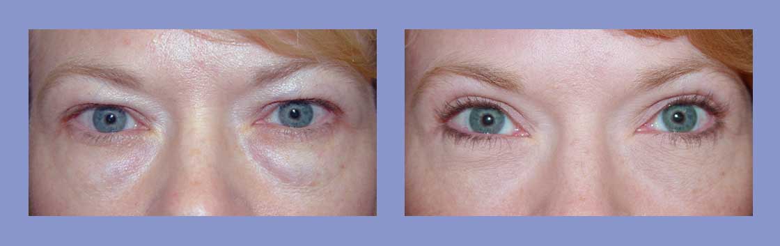 Eyelid Surgery - Before and After