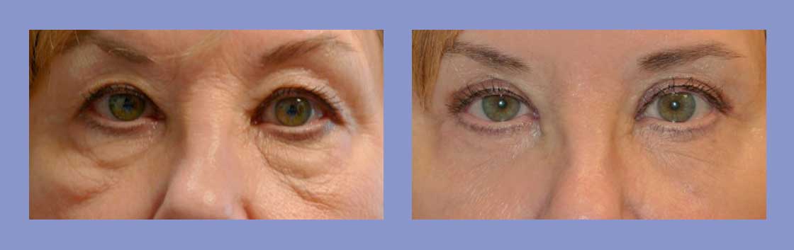 Eyelid Surgery - Before and After