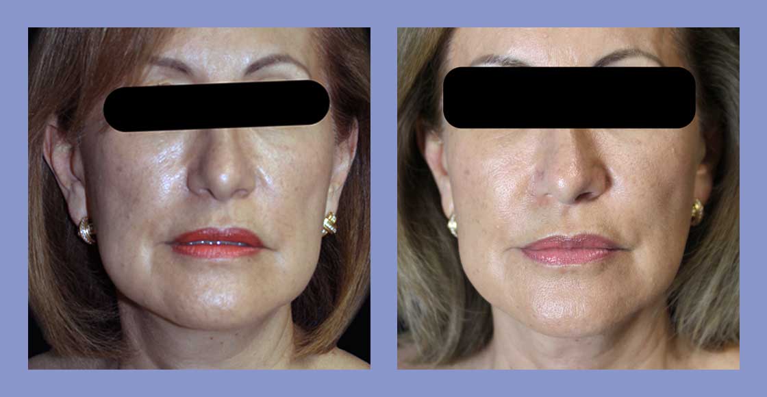 Facial Fat Grafting - Before and After