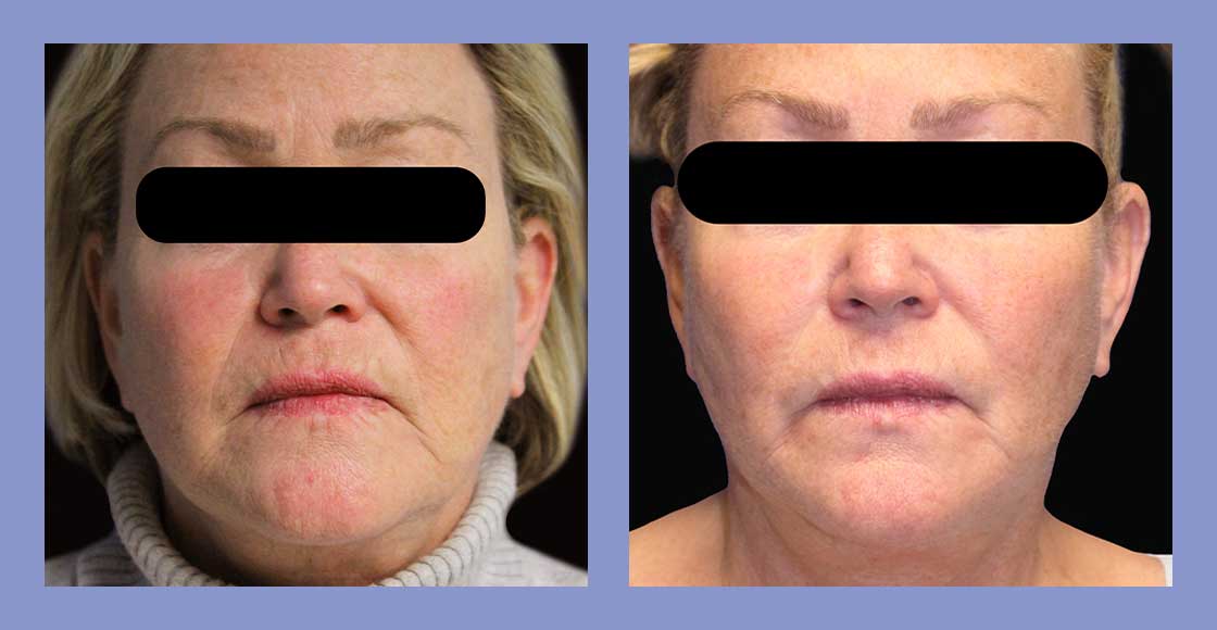 Facial Fat Grafting - Before and After