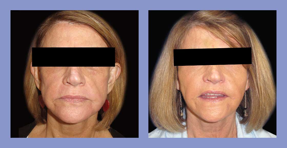 Facial Fat Grafting - Before and After