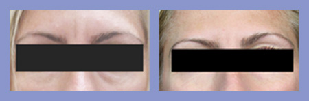 Med Spa botox before and after