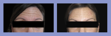 Med Spa botox before and after