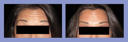 Med Spa botox before and after