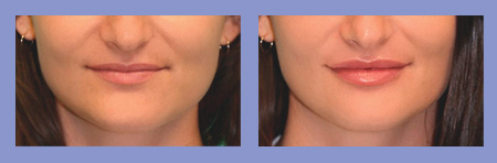 Med Spa dermal fillers before and after