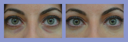 Med Spa dermal fillers before and after