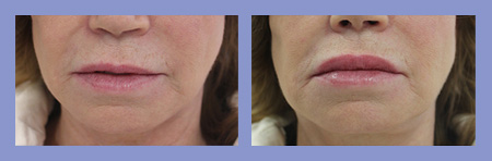 Med Spa dermal fillers before and after