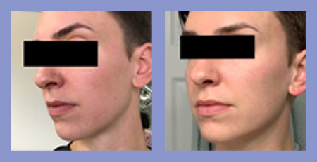 Med Spa microneedling PRP before and after