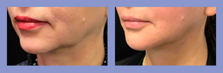 Med Spa PDO thread lift before and after