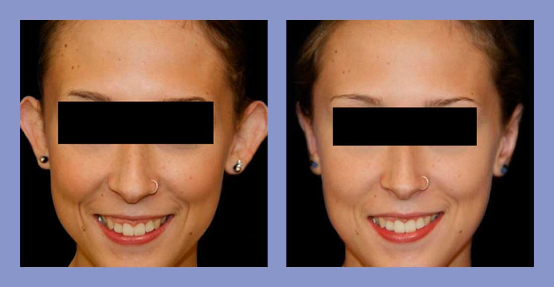 Otoplasty - Before and After
