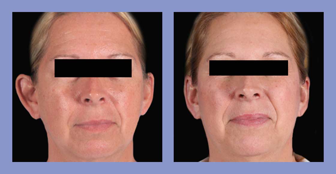 Otoplasty - Before and After