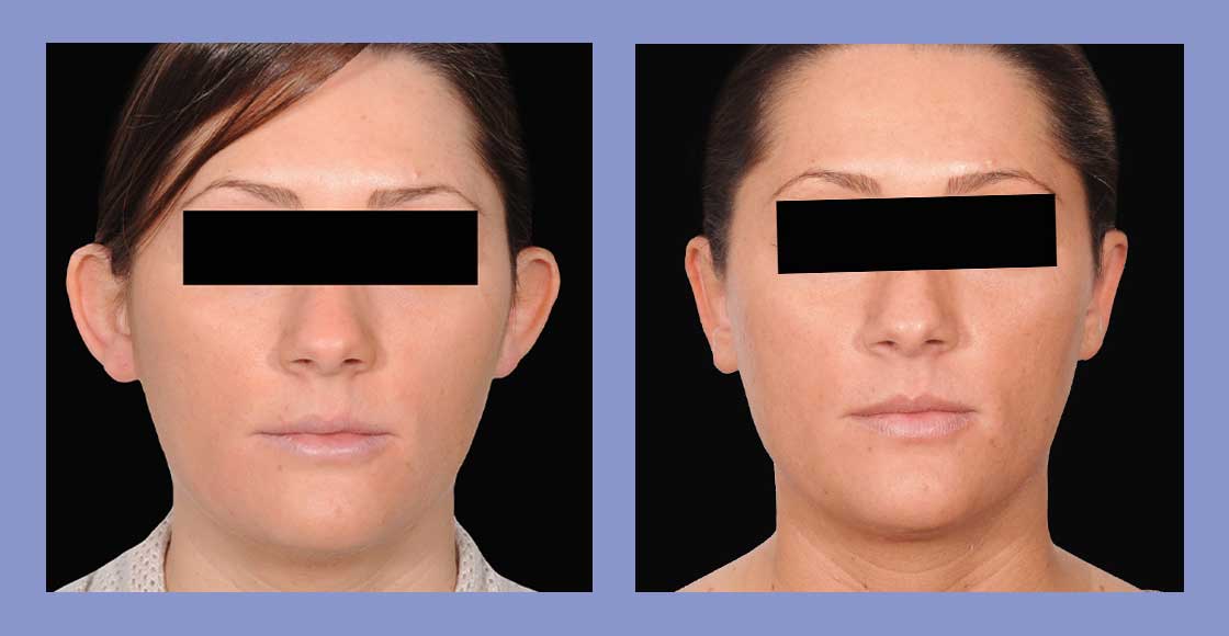 Otoplasty - Before and After