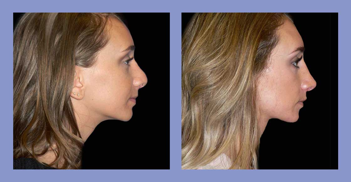 Rhinoplasty - Before and After