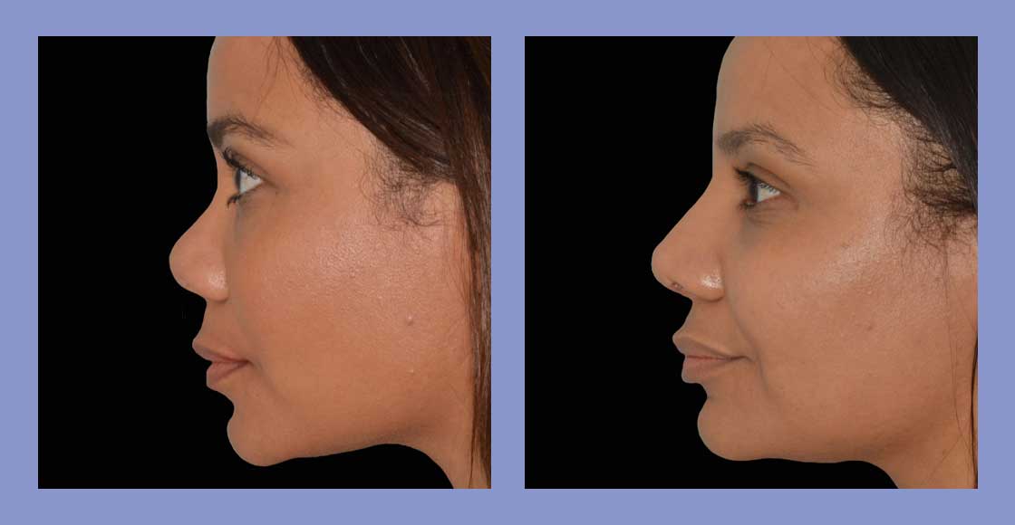 Rhinoplasty - Before and After