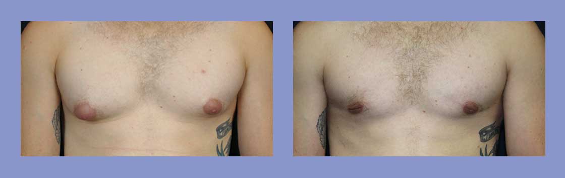 Male Breast Reduction - Before and After