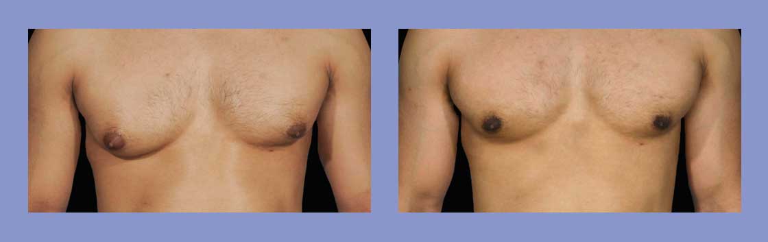 Male Breast Reduction - Before and After