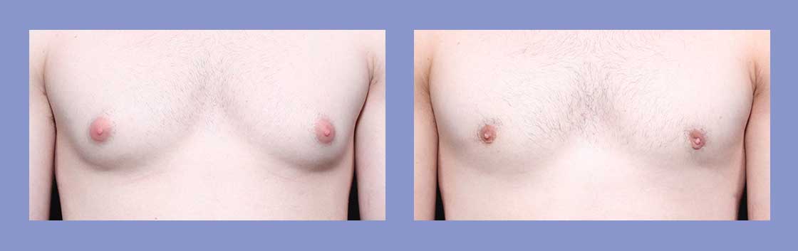 Male Breast Reduction - Before and After