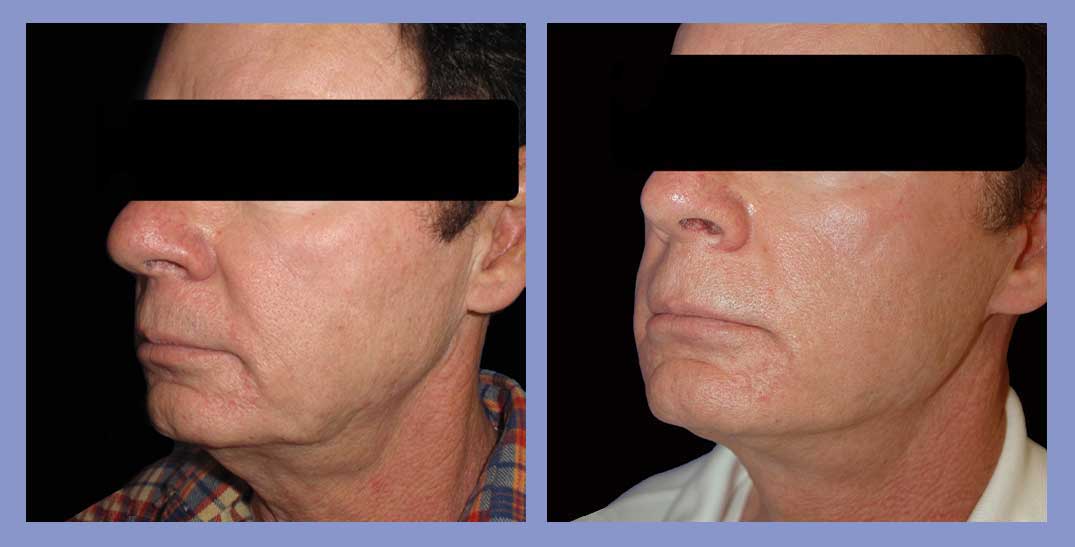 Male Facial Fat Grafting - Before and After