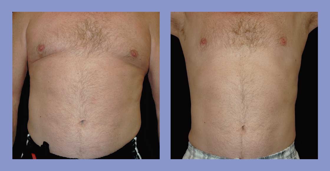Male Liposuction - Before and After