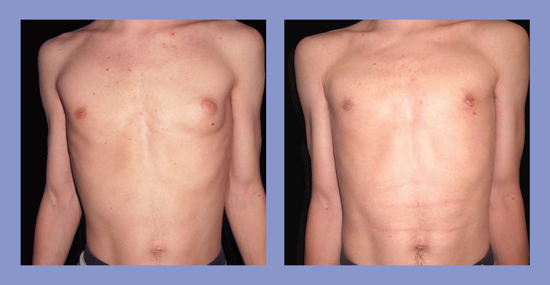 Male Liposuction - Before and After