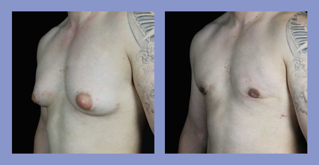 Male Liposuction - Before and After