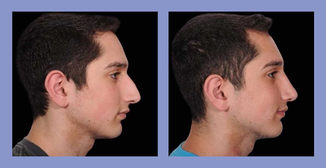 Male Rhinoplasty - Before and After