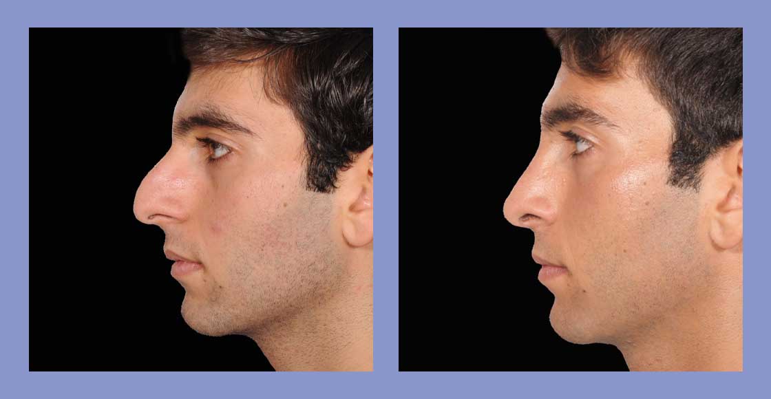 Male Rhinoplasty - Before and After