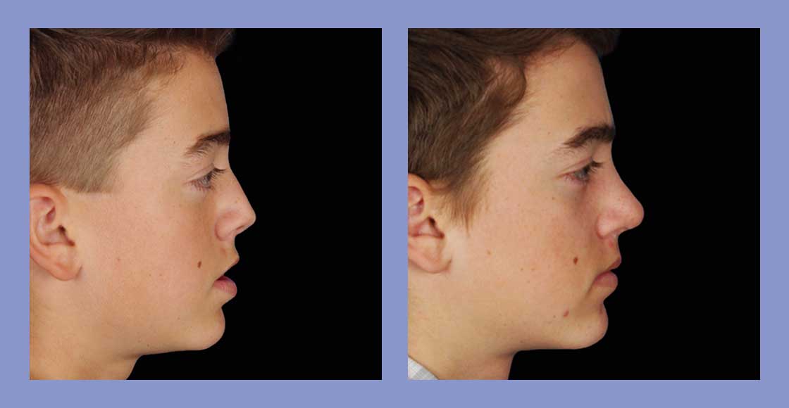 Male Rhinoplasty - Before and After