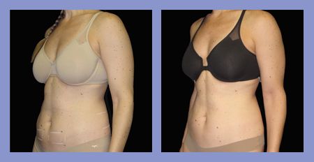 Med Spa SculpSure before and after