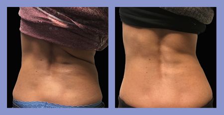 Med Spa SculpSure before and after