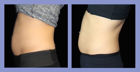 Med Spa SculpSure before and after