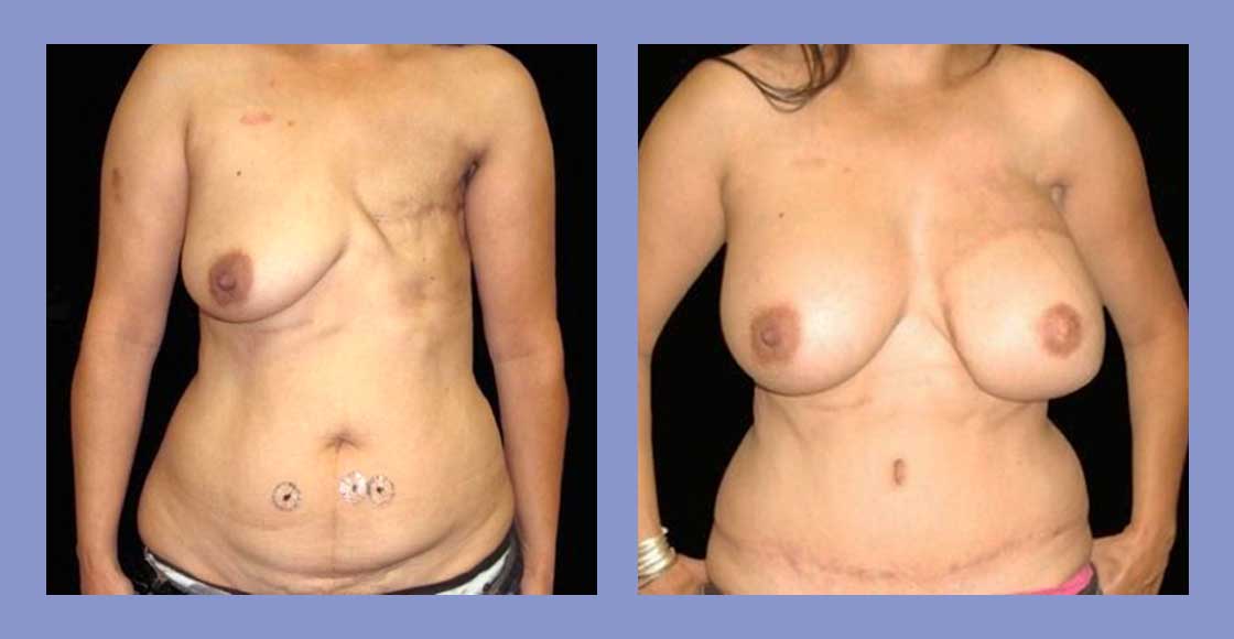 DIEP flap - Before and After