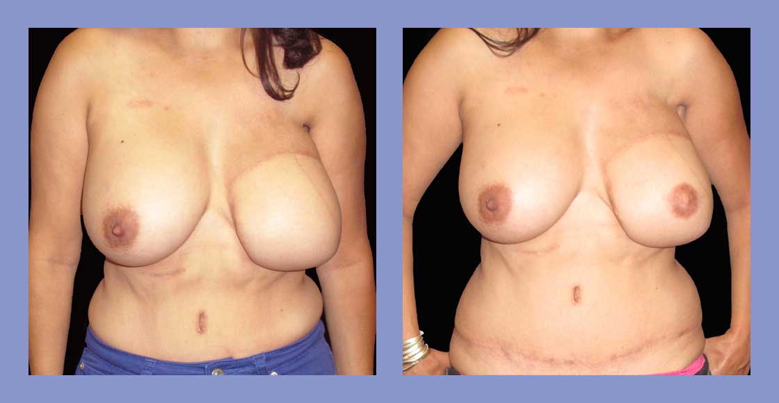 DIEP flap - Before and After