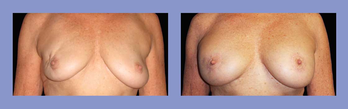 Lumpectomy Reconstruction - Before and After