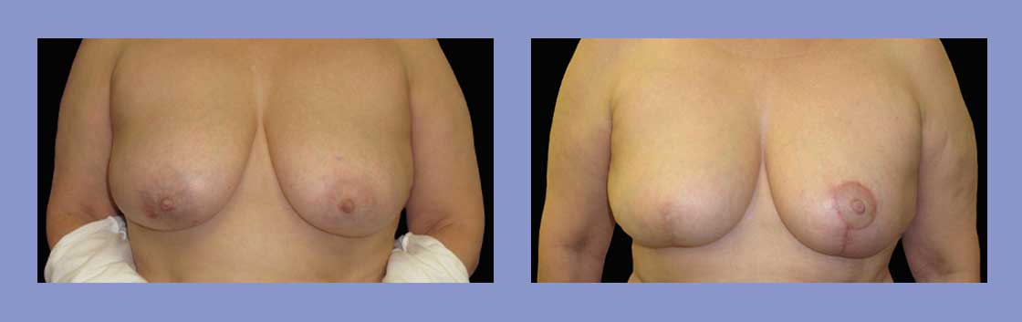 Lumpectomy Reconstruction - Before and After