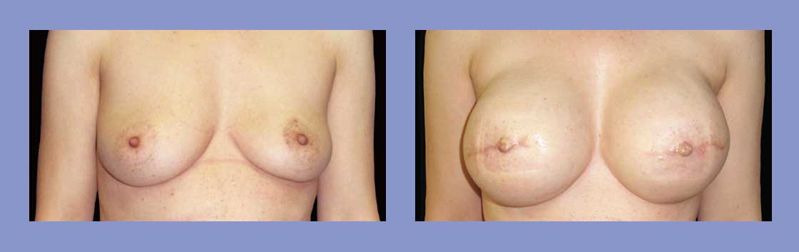 Nipple Reconstruction - Before and After