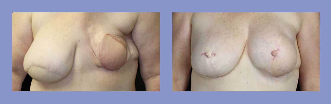 Nipple Reconstruction - Before and After