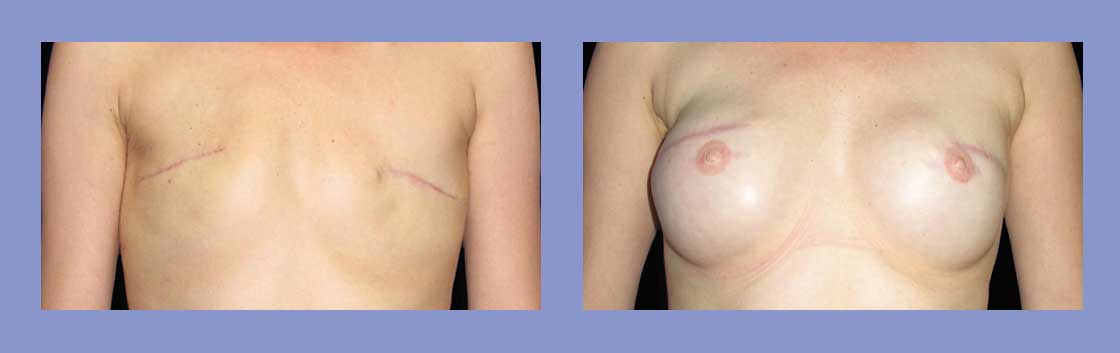 Nipple Reconstruction - Before and After