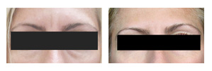 Testimonial botox before and after