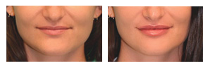 Testimonial dermal fillers before and after