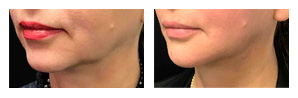 Testimonial PDO thread lift before and after