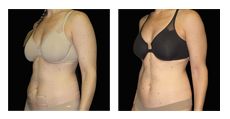 Med Spa SculpSure before and after