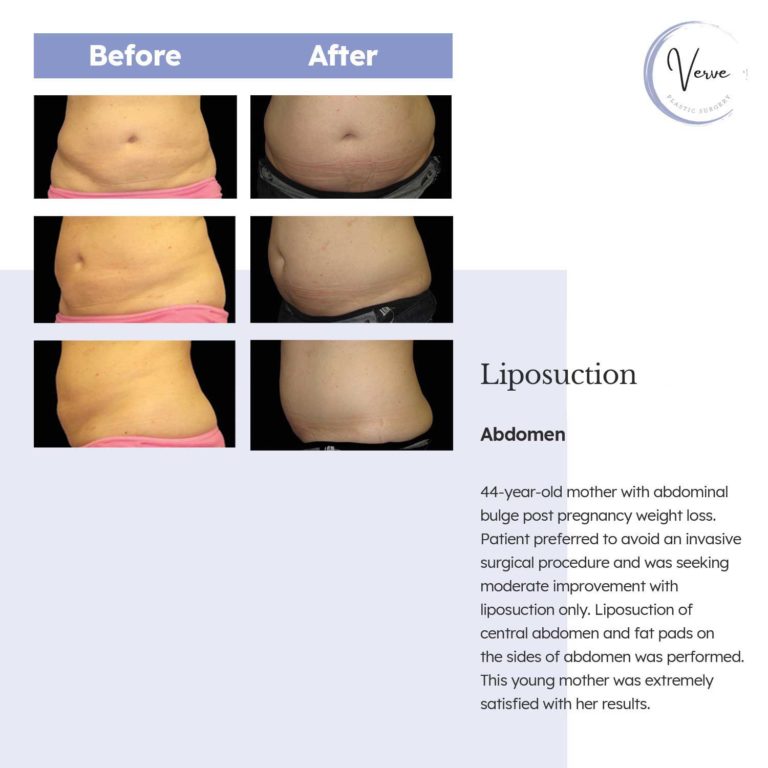 Before and After images of Liposuction, Abdomen - 44 year old mother with abdominal bulge post pregnancy weight loss. Patient preferred to avoid an invasive surgical procedure and was seeking moderate improvement with liposuction only. Liposuction of central abdomen and fat pads on the sides of abdomen was performed. This young mother was extremely satisfied with her results.