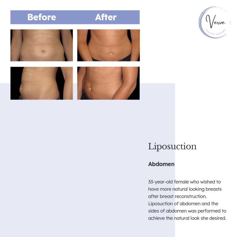Before and After images of Liposuction, Abdomen - 33 year old female who wished to have more natural looking breasts after breast reconstruction. Liposuction of abdomen and the sides of abdomen was performed to achieve the natural look she desired.