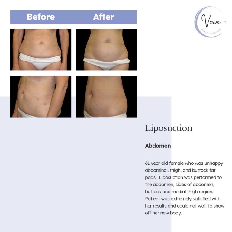 Before and After images of Liposuction, Abdomen - 61 year old female who was unhappy abdominal, thigh, and buttock fat pads. Liposuction was performed to the abdomen, sides of abdomen, buttock and medial thigh region. Patient was extremely satisfied with her results and could not wait to show off her new body.
