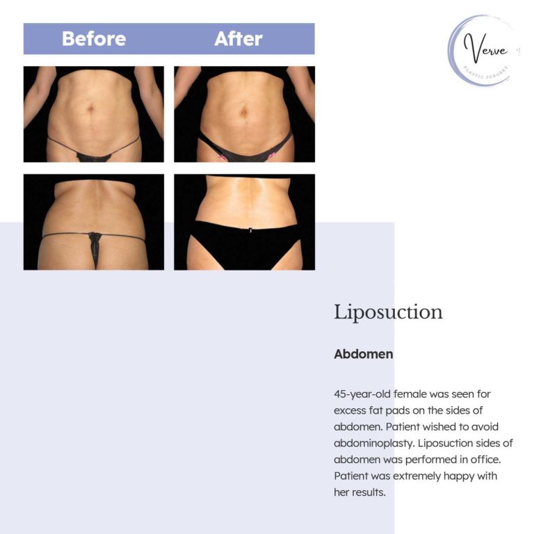 Before and After images of Liposuction, Abdomen - 45 year old female was seen for excess fat pads on the sides of abdomen. Patient wished to avoid abdominoplasty. Liposuction sides of abdomen was performed in office. Patient was extremely happy with her results.
